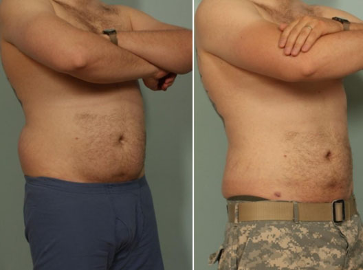 Why Choose Turkey for Liposuction? 1 ba 6